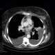 Thrombosis of pulmonary vein: CT - Computed tomography